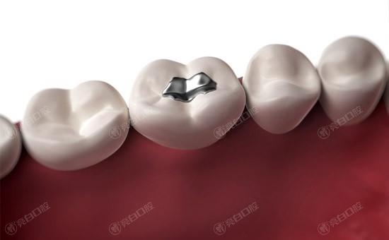 我左邊牙齒根部，牙洞很大，一吃飯就塞。這種情況是必須補(bǔ)牙嗎？